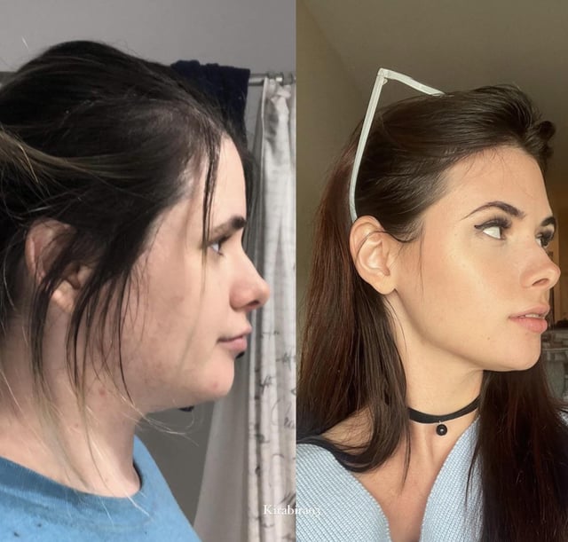 F/28/5’3 [158 > 119= 39lb] (18 months ) Weightloss 🙂 side face profile