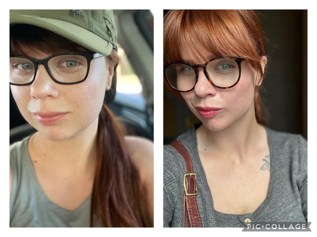 F/31/5'3" [189lbs > 153lbs = 37lbs] (12 months) Face gains after 1 year on Wellbutrin.