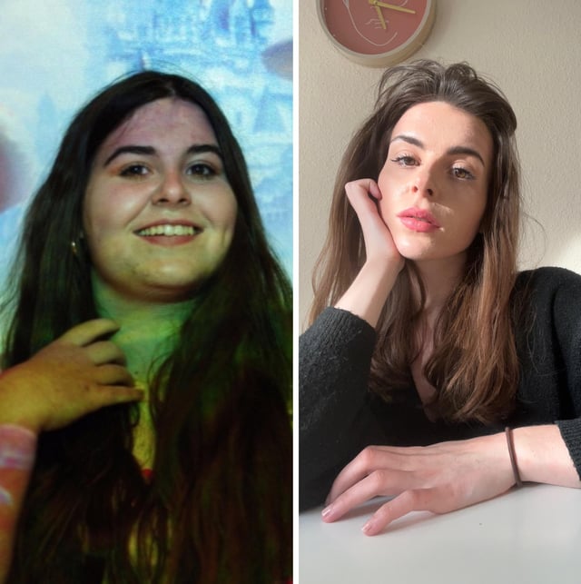 F/22/5‘6‘‘[94kg>53kg=41kg] got dumped because of my weight, lost weight, got dumped because of loose Skin. Two times. Decided to forget about men and Focus on myself Now!