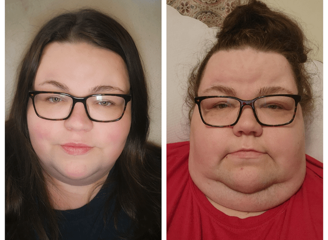 F/32/5'5 [386>306=80lbs lost] since June 2022. Got diagnosised with diabetes after a super close call with covid. Started low carb and walking. Major skin and hair improvement too