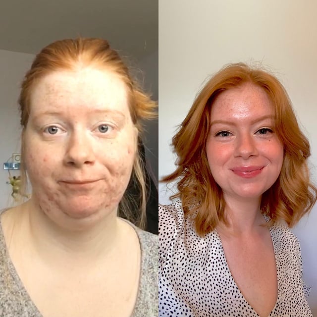 F/22/5’5 [190 > 129 = -61lbs] I used to be afraid of having short hair cause of the weight in my face. today, i said goodbye to the old me and embraced my new life!